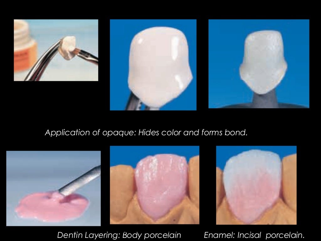 Dental ceramics / cosmetic dentistry course in india.