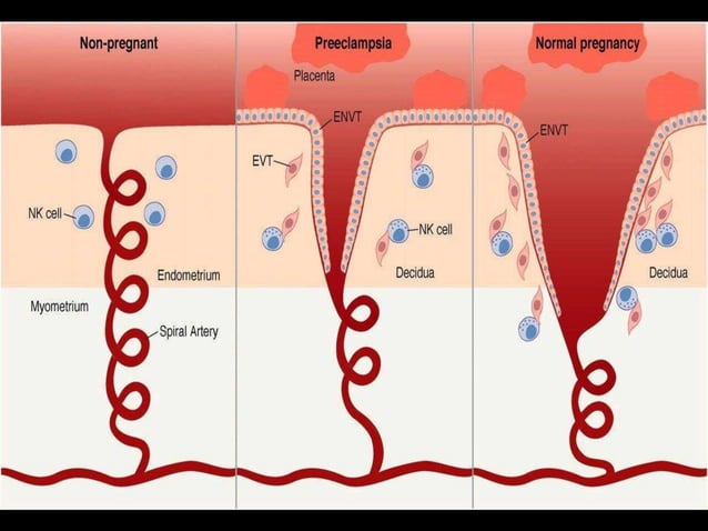 pre eclampsia | PPTX