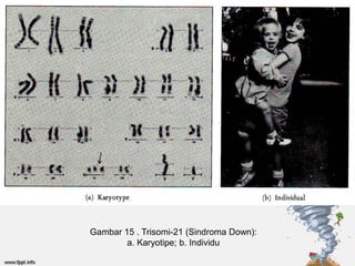 Gambar 15 . Trisomi-21 (Sindroma Down):
        a. Karyotipe; b. Individu
 