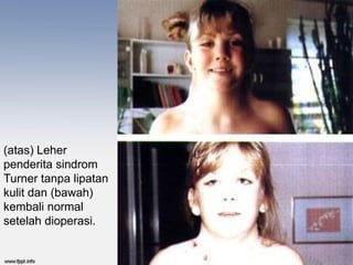 (atas) Leher
penderita sindrom
Turner tanpa lipatan
kulit dan (bawah)
kembali normal
setelah dioperasi.
 