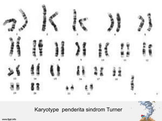 Karyotype penderita sindrom Turner
 