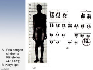 A. Pria dengan
   sindroma
   Klinefelter
   (47,XXY);
B. Karyotipe
 
