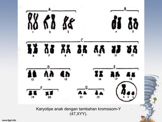 Karyotipe anak dengan tambahan kromosom-Y
                 (47,XYY).
 