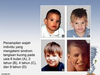 Penampilan wajah
individu yang
mengalami sindrom
tangisan kucing pada
usia 8 bulan (A), 2
tahun (B), 4 tahun (C),
dan 9 tahun (D)
 