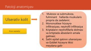 Patoloji anatomiyası
Ulserativ kolit
Kron xəstəliyi
1. Mukoza və submukoza,
fulminant hallarda muskularis
propria da zədələnir;
2. Mononuklear hüceyrə
infiltrasiyası, neytrofil infiltrasiya
3. Kriptaların neytrofillərlə dolması
və krtiptada abseslərin əmələ
gəlməsi;
4. Səthi epitel qatının ulserasiyası
və Goblet hüceyrə itkisi
meydana gəlir
 