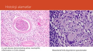 Histoloji əlamətlər
A crypt abscess demonstrating active, neutrophilic
inflammation in Crohn disease. Mezenterial limfa düyünlərinin qranulomaları
 