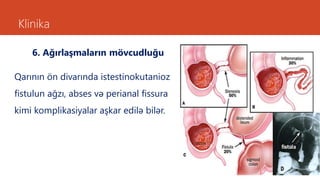 Klinika
6. Ağırlaşmaların mövcudluğu
Qarının ön divarında istestinokutanioz
fistulun ağzı, abses və perianal fissura
kimi komplikasiyalar aşkar edilə bilər.
 