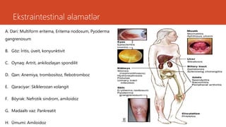 A. Dəri: Multiform eritema, Eritema nodosum, Pyoderma
gangrenosum
B. Göz: İritis, üveit, konyunktivit
C. Oynaq: Artrit, ankilozlaşan spondilit
D. Qan: Anemiya, trombositoz, flebotromboz
E. Qaraciyər: Sklklerozan xolangit
F. Böyrək: Nefrotik sindrom, amiloidoz
G. Mədəaltı vəz: Pankreatit
H. Ümumi: Amiloidoz
Ekstraintestinal əlamətlər
 