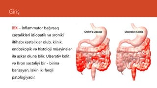 Giriş
İBX – İnflammator bağırsaq
xəstəlikləri idiopatik və xroniki
iltihabı xəstəliklər olub, klinik,
endoskopik və histoloji müayinələr
ilə aşkar oluna bilir. Ulserativ kolit
və Kron xəstəliyi bir - birinə
bənzəyən, lakin iki fərqli
patologiyadır.
 