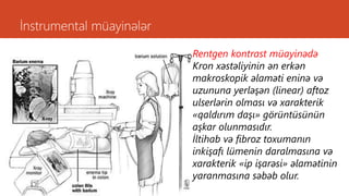 İnstrumental müayinələr
Rentgen kontrast müayinədə
Kron xəstəliyinin ən erkən
makroskopik əlaməti eninə və
uzununa yerləşən (linear) aftoz
ulserlərin olması və xarakterik
«qaldırım daşı» görüntüsünün
aşkar olunmasıdır.
İltihab və fibroz toxumanın
inkişafı lümenin daralmasına və
xarakterik «ip işarəsi» əlamətinin
yaranmasına səbəb olur.
 