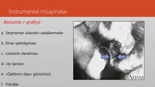 İnstrumental müayinələr
- Bariumlu r-qrafiya:
a. Seqmentar ulserativ zədələnmələr
b. Divar qalınlaşması
c. Lümenin daralması
d. «İp işarəsi»
e. «Qaldırım daşı» görüntüsü
f. Fistullar
 