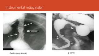 İnstrumental müayinələr
Qaldirim daşı əlaməti İp işarəsi
 
