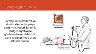 Endoskopik müayinə
Patoloji kütlələrdən və ya
strikturalardan biopsiya
götürmək, yaxud Bariumlu
rentgenoqrafiyada
görünən dolma defektinin
daha dəqiq görmək üçün
istifadə olunur.
 