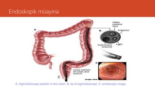 Endoskopik müayinə
A, Sigmoidoscope position in the colon; B, tip of sigmoidoscope; C, endoscopic image.
 