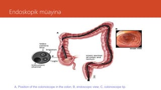 Endoskopik müayinə
A, Position of the colonoscope in the colon; B, endoscopic view; C, colonoscope tip.
 