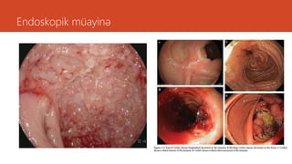 Endoskopik müayinə
 
