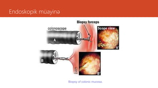 Endoskopik müayinə
Biopsy of colonic mucosa.
 