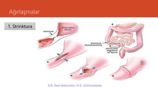 Ağırlaşmalar
1. Strinktura
A,B, Ileal obstruction; C-E, stricturoplasty
 