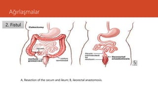 Ağırlaşmalar
A, Resection of the cecum and ileum; B, ileorectal anastomosis.
2. Fistul
 