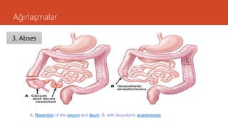 Ağırlaşmalar
A, Resection of the cecum and ileum; B, with ileocolonic anastomosis
3. Abses
 