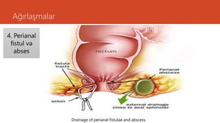 Ağırlaşmalar
4. Perianal
fistul və
abses
Drainage of perianal fistulae and abscess.
 