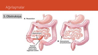 Ağırlaşmalar
5. Obstruksiya
 
