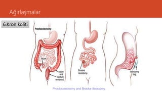 Ağırlaşmalar
6.Kron koliti
Proctocolectomy and Brooke ileostomy.
 