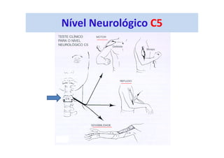 Nível Neurológico C5
 