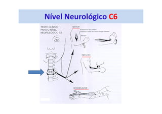 Nível Neurológico C6
 