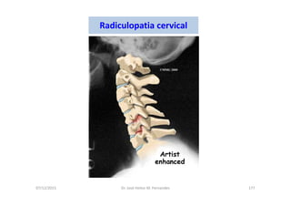 07/12/2015 Dr. José Heitor M. Fernandes 177
Radiculopatia cervical
 