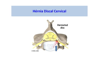 Hérnia Discal Cervical
 