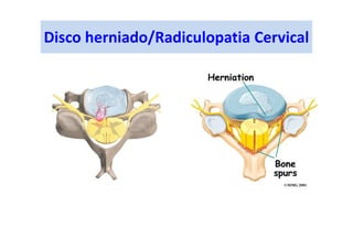 Disco herniado/Radiculopatia Cervical
 