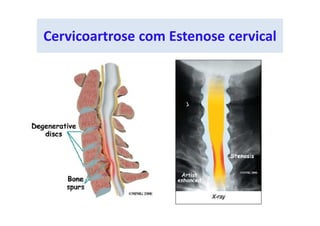 Cervicoartrose com Estenose cervical
 