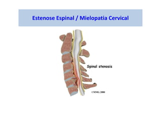 Estenose Espinal / Mielopatia Cervical
 