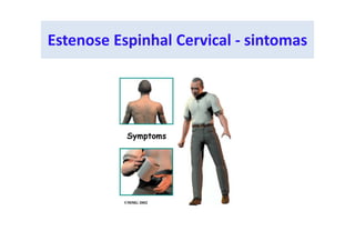 Estenose Espinhal Cervical - sintomas
 