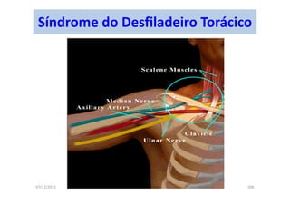 07/12/2015 206
Síndrome do Desfiladeiro Torácico
 