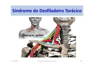 07/12/2015 Dr. José Heitor Machado Fernandes 208
Síndrome do Desfiladeiro Torácico
 