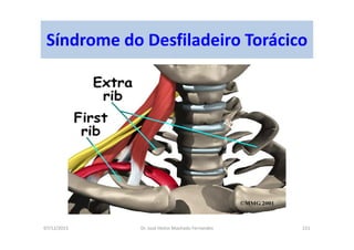07/12/2015 Dr. José Heitor Machado Fernandes 221
Síndrome do Desfiladeiro Torácico
 