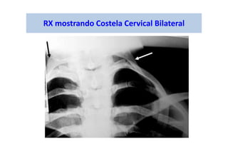 RX mostrando Costela Cervical Bilateral
 