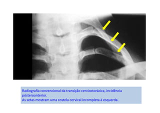 Radiografia convencional da transição cervicotorácica, incidência
pósteroanterior.
As setas mostram uma costela cervical incompleta à esquerda.
 