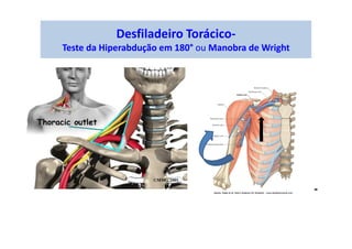 Desfiladeiro Torácico-
Teste da Hiperabdução em 180° ou Manobra de Wright
 