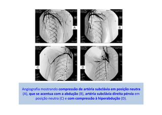 Angiografia mostrando compressão de artéria subclávia em posição neutra
(A), que se acentua com a abdução (B), artéria subclávia direita pérvia em
posição neutra (C) e com compressão à hiperabdução (D).
 