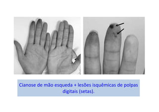Cianose de mão esqueda + lesões isquêmicas de polpas
digitais (setas).
 