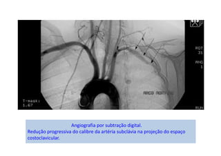 Angiografia por subtração digital.
Redução progressiva do calibre da artéria subclávia na projeção do espaço
costoclavicular.
 
