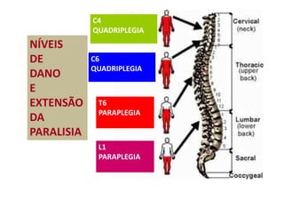 C4
QUADRIPLEGIA
C6
QUADRIPLEGIA
T6
PARAPLEGIA
L1
PARAPLEGIA
NÍVEIS
DE
DANO
E
EXTENSÃO
DA
PARALISIA
 