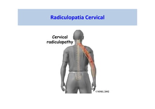 Radiculopatia Cervical
 