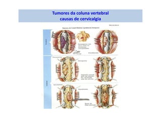 figura
Tumores da coluna vertebral
causas de cervicalgia
 
