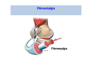 Fibromialgia
 
