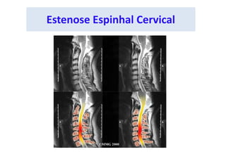 Estenose Espinhal Cervical
 