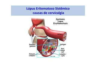 Lúpus Eritematoso Sistêmico
causas de cervicalgia
 